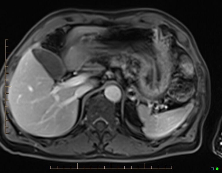 File:Chronic pancreatitis (Radiopaedia 17014-16716 Axial T1 C+ fat sat 18).jpg