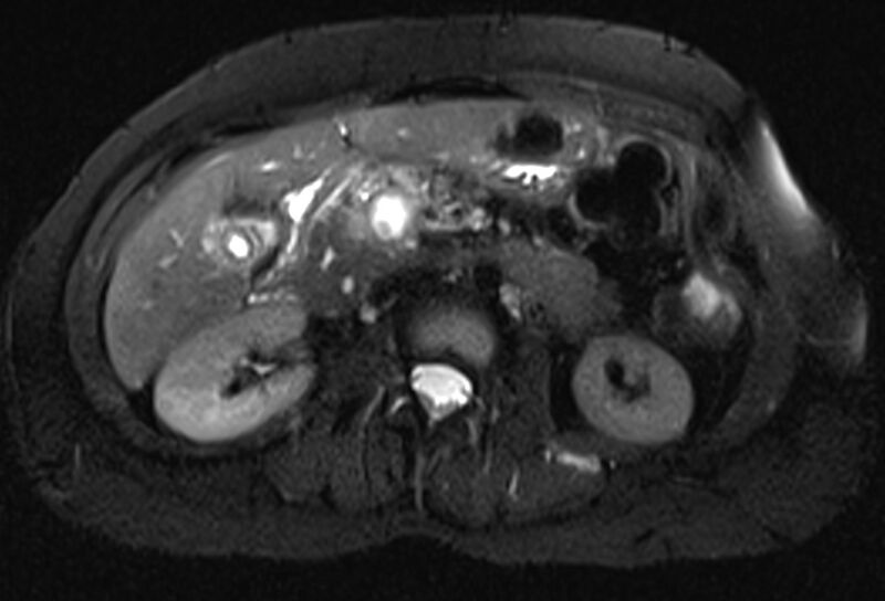 File:Chronic pancreatitis - pancreatic duct calculi (Radiopaedia 71818-82250 Axial T2 fat sat 34).jpg