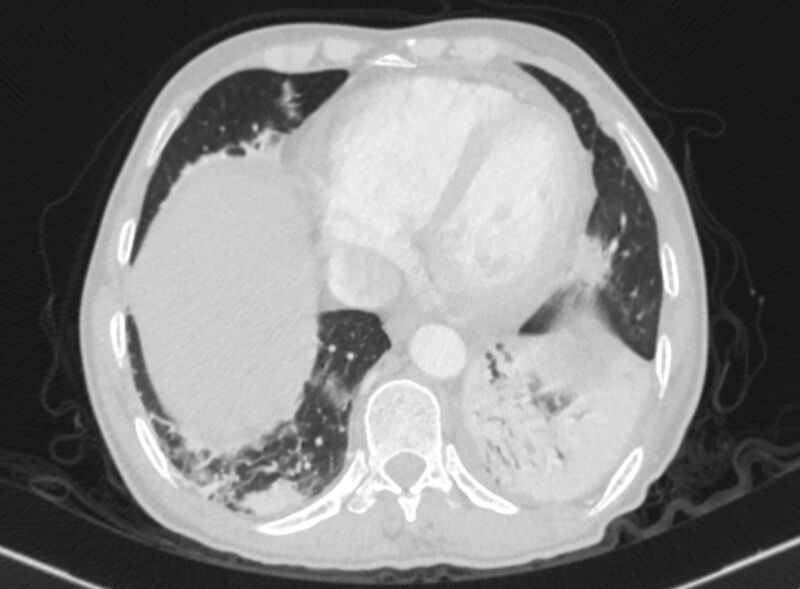 File:Chronic pulmonary embolism with bubbly consolidation (Radiopaedia 91248-108850 Axial lung window 122).jpg