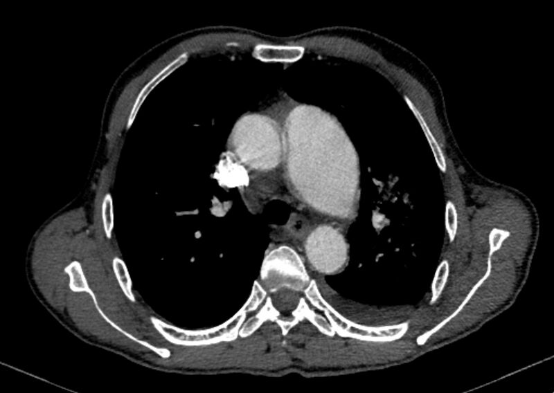 File:Chronic pulmonary embolism with bubbly consolidation (Radiopaedia 91248-108850 C+ arterial phase 50).jpg