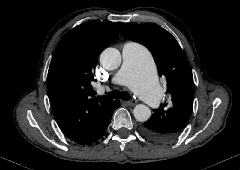 File:Chronic pulmonary embolism with bubbly consolidation (Radiopaedia 91248-108850 C+ arterial phase 59).jpg