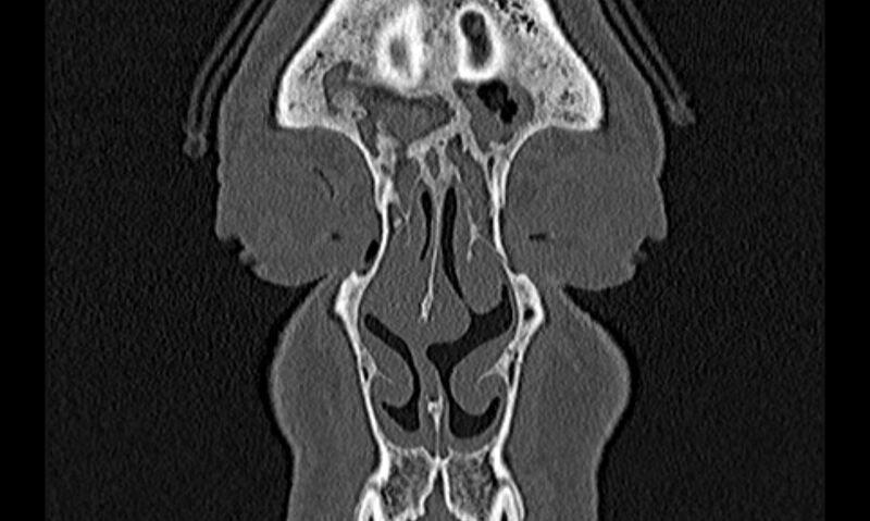File:Chronic rhinosinusitis (Radiopaedia 65079-74075 Coronal bone window 9).jpg