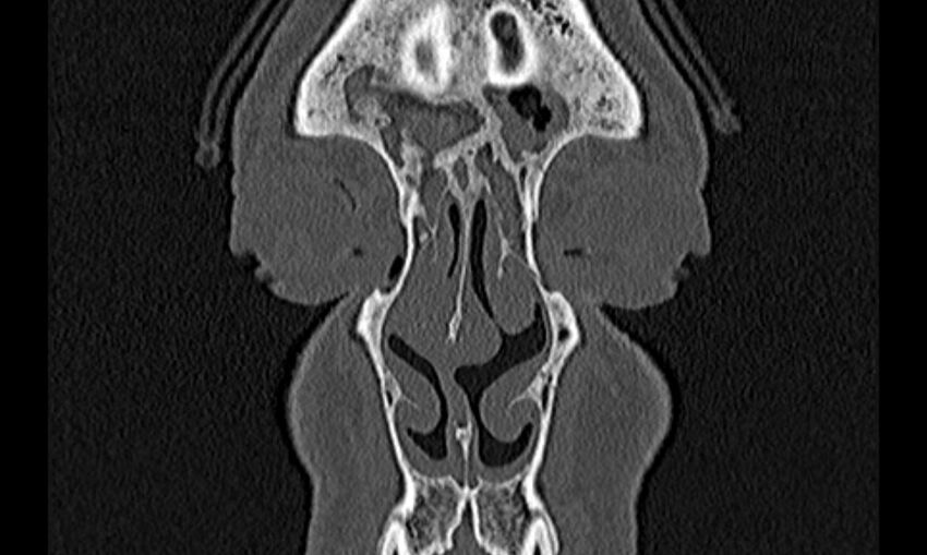 Chronic rhinosinusitis (Radiopaedia 65079-74075 Coronal bone window 9).jpg