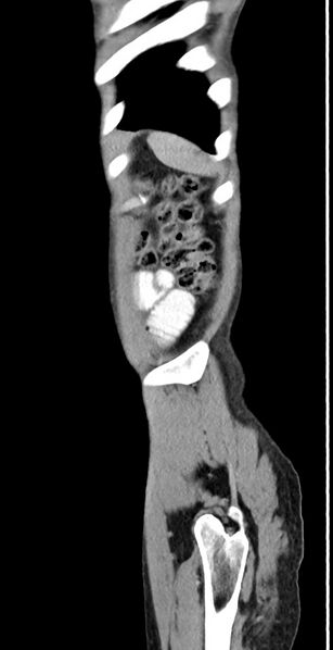 File:Chronic small bowel volvulus (Radiopaedia 75224-86322 C 19).jpg