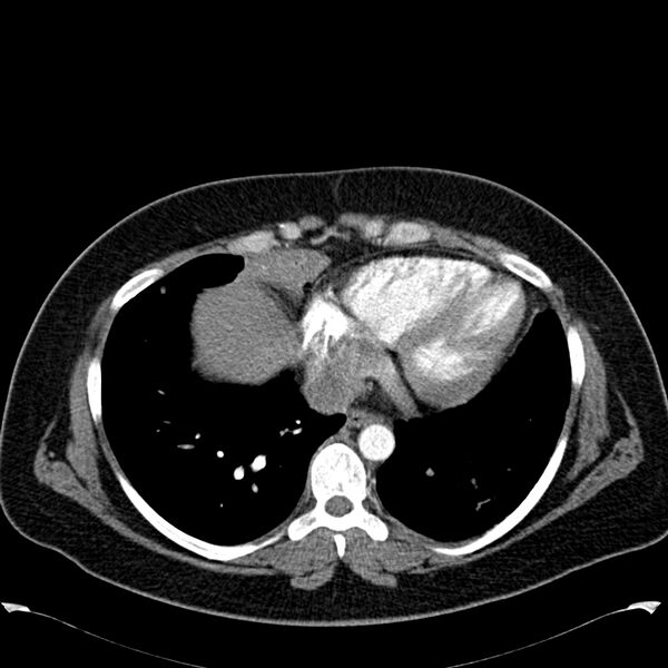 File:Chronic thromboembolic pulmonary hypertension (CTEPH) (Radiopaedia 74597-85531 Axial C+ CTPA 37).jpg