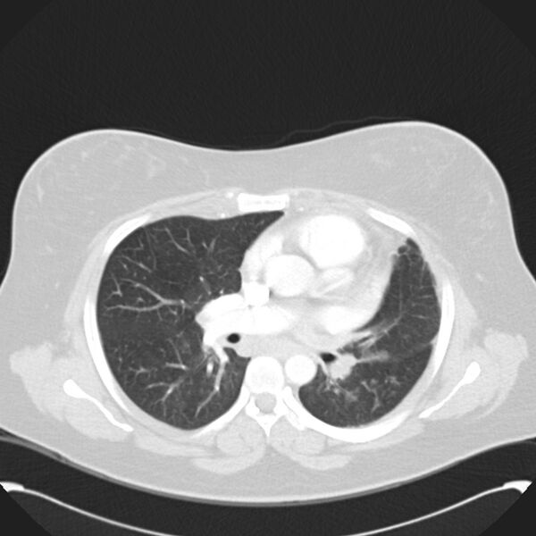 File:Chronic thromboembolic pulmonary hypertension (CTEPH) (Radiopaedia 74597-85531 Axial lung window 25).jpg