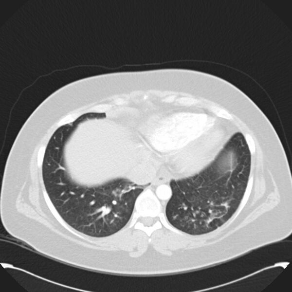 File:Chronic thromboembolic pulmonary hypertension (CTEPH) (Radiopaedia 74597-85531 Axial lung window 39).jpg