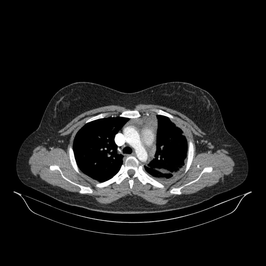 Chronic thromboembolic pulmonary hypertension (CTEPH) (Radiopaedia 74597-85532 Axial C+ CTPA 112).jpg
