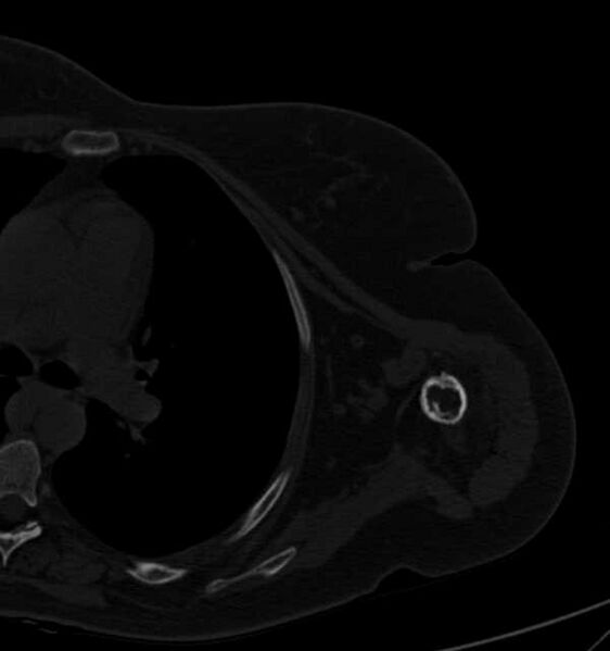 File:Clear cell chondrosarcoma - humerus (Radiopaedia 63104-71612 Axial bone window 74).jpg