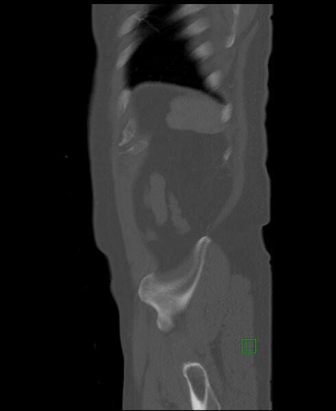 File:Clear cell renal cell carcinoma (Radiopaedia 85006-100539 Sagittal bone window 7).jpg