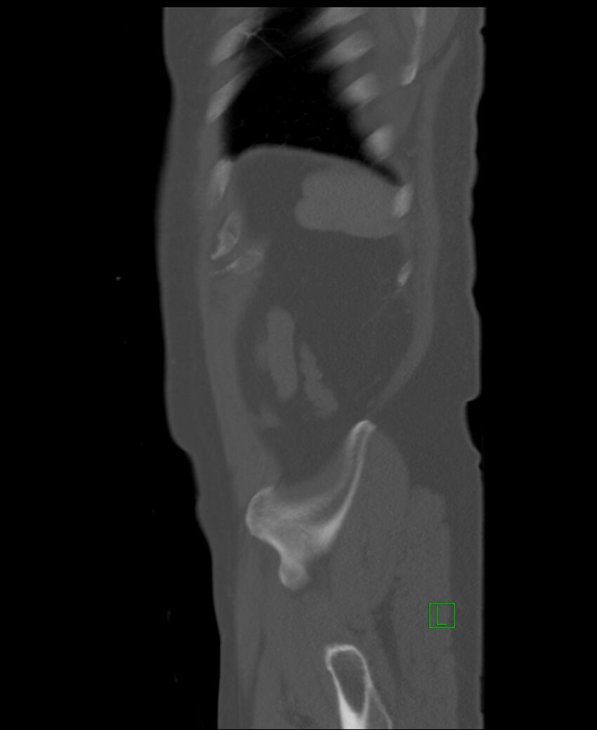 Clear cell renal cell carcinoma (Radiopaedia 85006-100539 Sagittal bone window 7).jpg