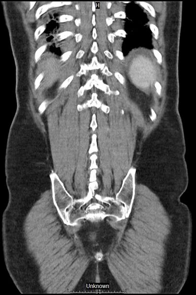 File:Closed loop bowel obstruction and ischemia (Radiopaedia 86959-103180 B 41).jpg