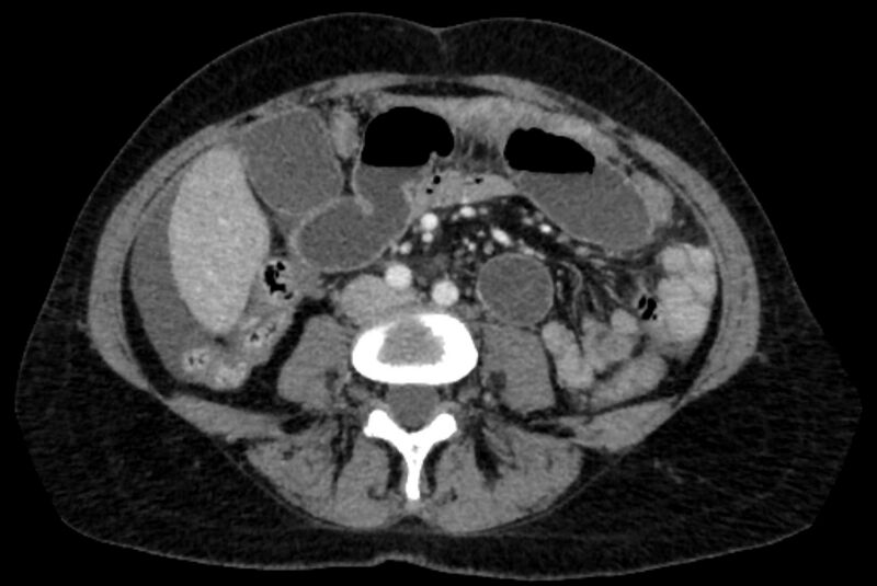 File:Closed loop small bowel obstruction (Radiopaedia 71211-81508 A 69).jpg