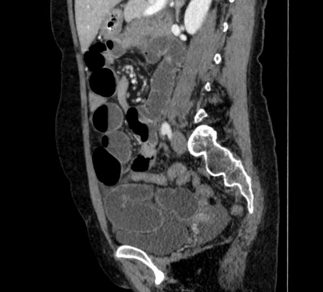 File:Closed loop small bowel obstruction (Radiopaedia 71211-81508 C 95).jpg