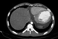 Coarctation of aorta with aortic valve stenosis (Radiopaedia 70463-80574 A 196).jpg
