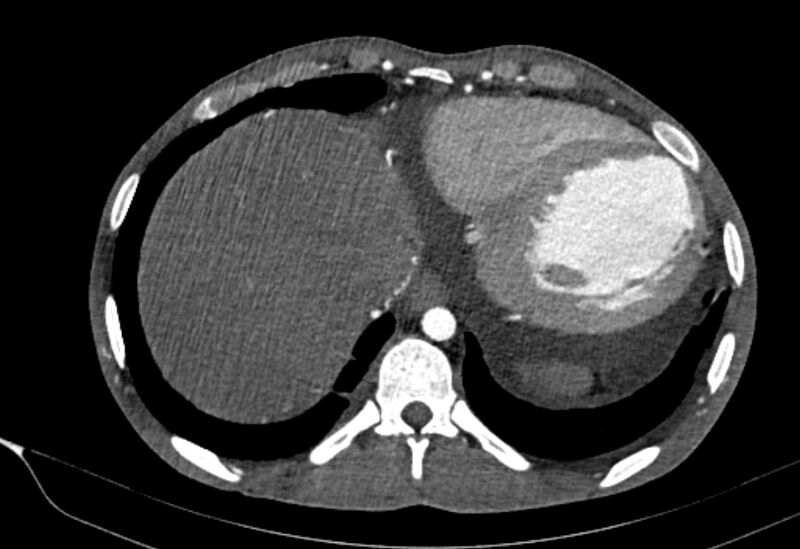 File:Coarctation of aorta with aortic valve stenosis (Radiopaedia 70463-80574 A 196).jpg