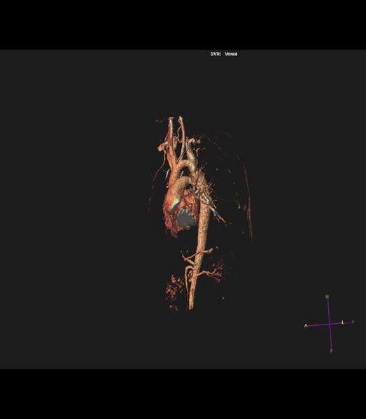 File:Coarctation of the aorta (Radiopaedia 43373-46729 3D reconstruction 18).jpg