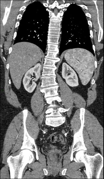 File:Coarctation of the aorta (Radiopaedia 74632-88521 B 168).jpg