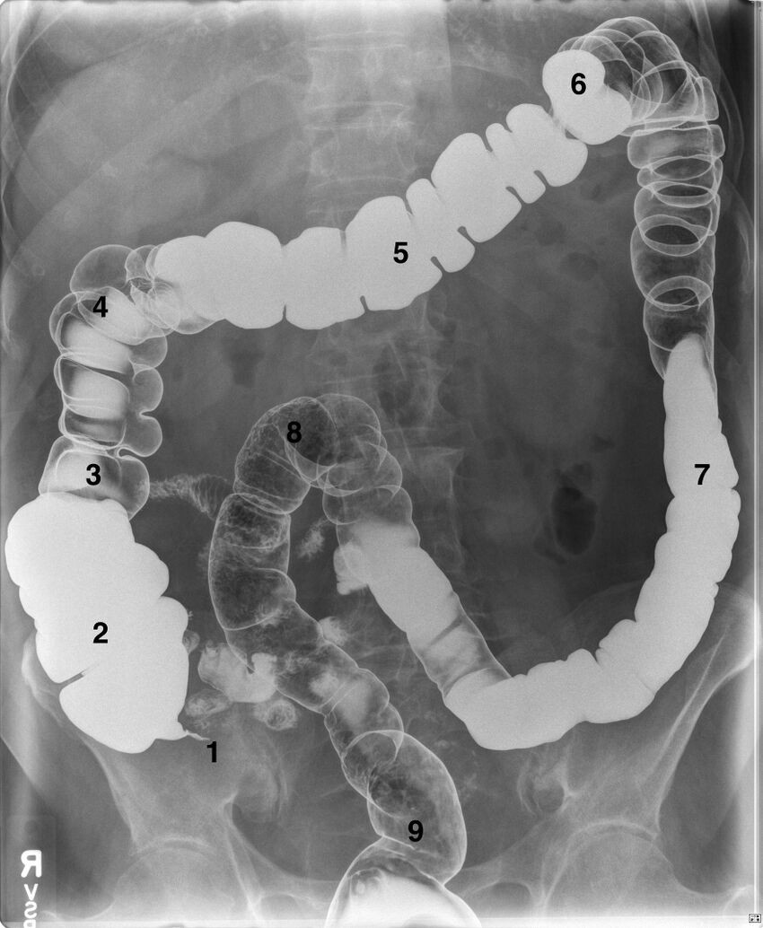 Figure 5.12 Colon anatomy emphasized by the distribution of barium and gas in the colon.jpg