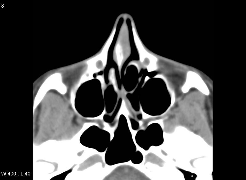 File:Nasolacrimal dacrocystocele (Radiopaedia 13814-13694 Axial liver window 8).jpg