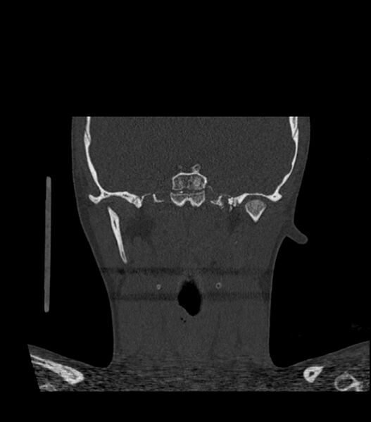 File:Nasoorbitoethmoid fracture (Radiopaedia 90044-107205 Coronal bone window 90).jpg