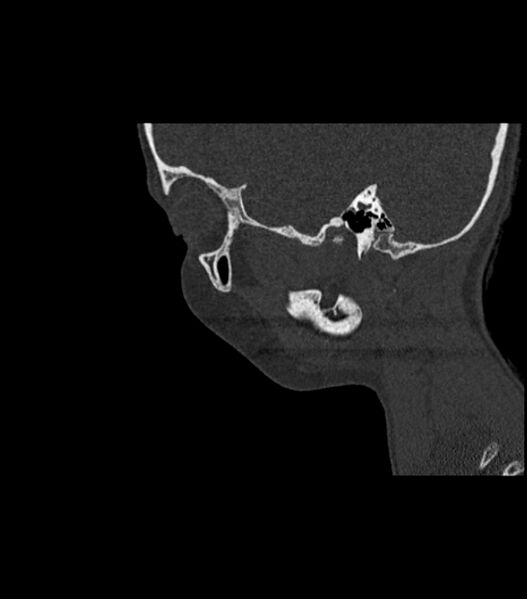 File:Nasoorbitoethmoid fracture (Radiopaedia 90044-107205 Sagittal bone window 38).jpg