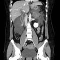 Necrotizing pancreatitis (Radiopaedia 23001-23031 B 36).jpg