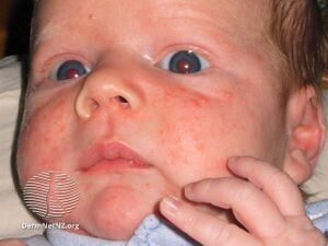 Neonatal acne (DermNet NZ acne-neonatal-acne).jpg