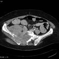 Nerve sheath tumor - malignant - sacrum (Radiopaedia 5219-6987 A 5).jpg