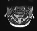Neurofibromatosis type 1 (Radiopaedia 80355-93740 Axial T2 6).jpg