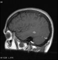 Neurosarcoidosis (Radiopaedia 10930-17204 Sagittal T1 C+ 3).jpg