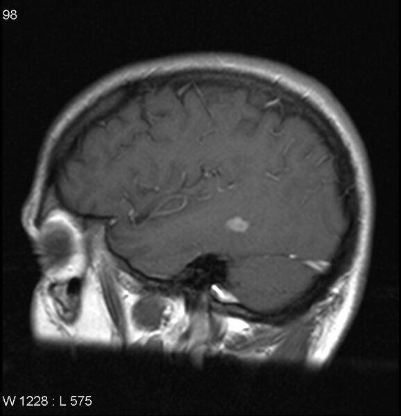 File:Neurosarcoidosis (Radiopaedia 10930-17204 Sagittal T1 C+ 3).jpg