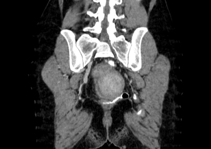 File:Non-puerperal uterine inversion (Radiopaedia 78343-91094 B 50).jpg