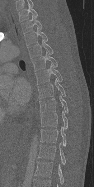 File:Normal CT thoracic spine (Radiopaedia 40181-42688 Sagittal bone window 29).png