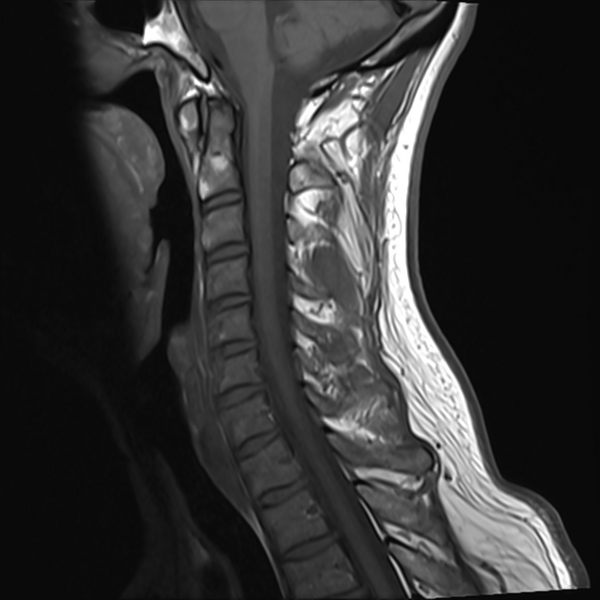 File:Normal MRI cervical spine (infection protocol) (Radiopaedia 53916-60039 Sagittal T1 8).png