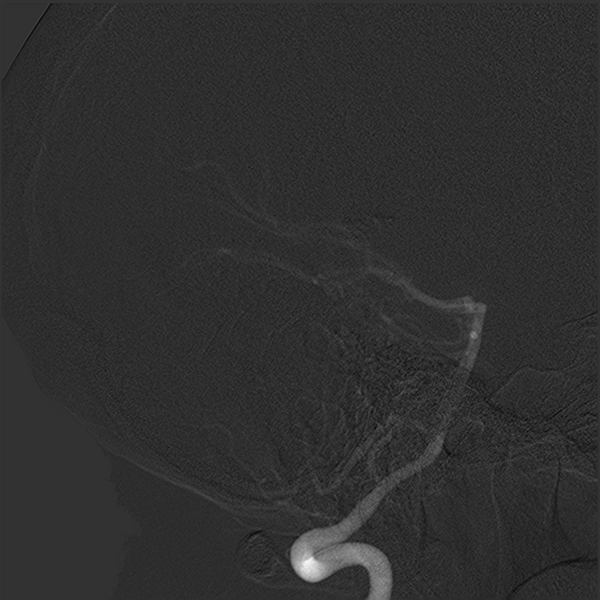 File:Normal cerebral angiogram (four vessel DSA) (Radiopaedia 41708-44649 R 8).png