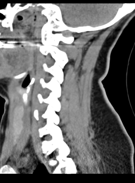 File:Normal cervical spine MRI (including Dixon) (Radiopaedia 42762-45926 C 41).png