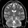 Normal coronal brain (Radiopaedia 6676-7910 Coronal T2 26).jpg