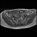 Normal female pelvis MRI (retroverted uterus) (Radiopaedia 61832-69933 Axial T1 10).jpg