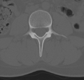 Normal lumbar spine CT (Radiopaedia 46533-50986 Axial bone window 37).png