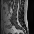 Normal lumbar spine MRI (Radiopaedia 35543-37039 Sagittal T2 7).png