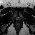 Normal prostate (MRI) (Radiopaedia 29986-30535 Axial T2 1).jpg