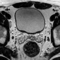 Normal prostate (MRI) (Radiopaedia 29986-30535 Axial T2 22).jpg