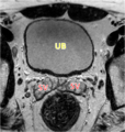 Normal prostate (MRI) (Radiopaedia 29986-30536 A 1).png