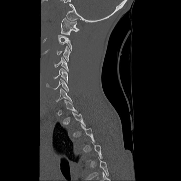 File:Normal trauma spine imaging (age 16) (Radiopaedia 45335-49358 Sagittal bone window 9).jpg