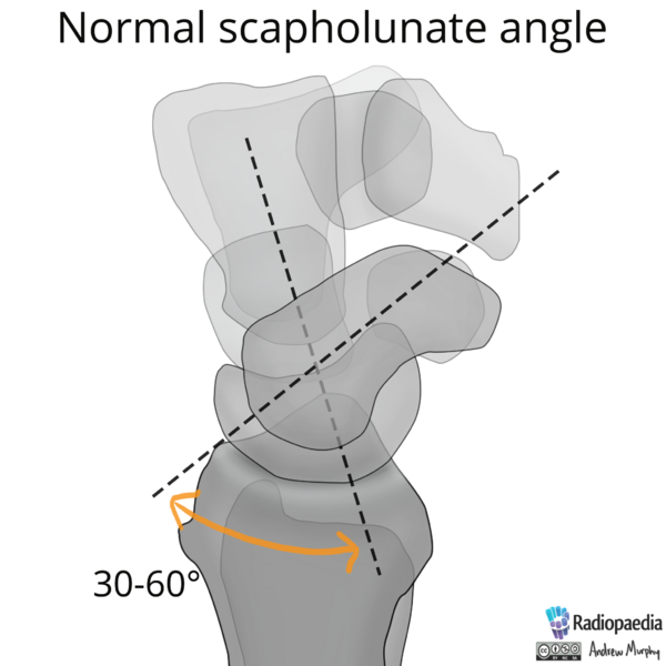 File:Normal wrist alignment, dorsal and volar intercalated segmental instability (illustration) (Radiopaedia 80949-94488 A 3).png