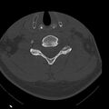 Occipital condyle fracture (Radiopaedia 31755-32691 Axial bone window 51).jpg