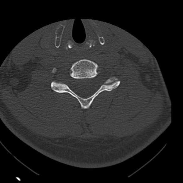 File:Occipital condyle fracture (Radiopaedia 31755-32691 Axial bone window 51).jpg