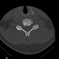 Occipital condyle fracture (Radiopaedia 31755-32691 Axial bone window 52).jpg