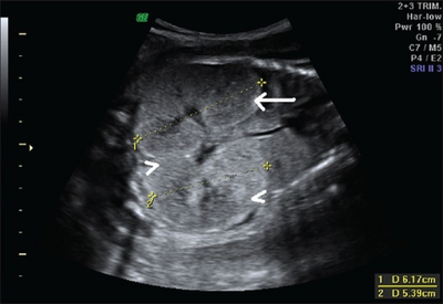 Fetus with bilateral enlarged/hyperechogenic kidneys arrow & diminished cortico-medullary differentiation arrowhead